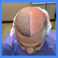 آموزش تخصصی کاشت موهمراه باکار با ارائه مدرک معتبر