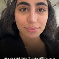 تخفیف لاین های زیبایی