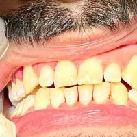 تخفیف جرمگیری و بروساژ دو فک به مدت محدود