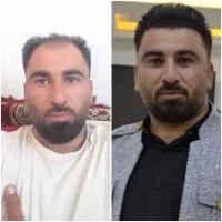 کاشت مو فقط با ۱۹ میلیون