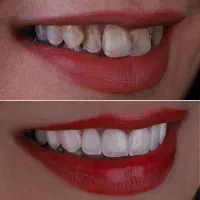 کامپوزیت دندان.پرداخت اقساط.عصب کشی.ایمپلنت.بیمه