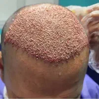 کاشت مو و ابرو شیرازی با تیم مجرب وشرایط اقساطی
