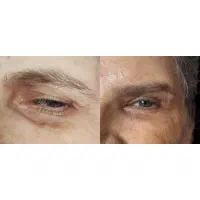 بلفارو پلاستی و دایرکت ابرو با بخیه لیزری