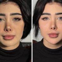 تزریق ژل (فیلر) بادی آنزیم بوتاکس مادلینگ لیفت مزو