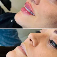 افر پایان بهار ویژه بوتاکس پیشانی و زیر بغل