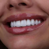 کامپوزیت دندان لمینت ایمپلنت