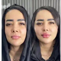 (آخرین روز جشنواره)بدون تزریق/هایفوفقط890ت/1جلسه