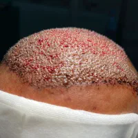 آموزش و استخدام کاشت مو