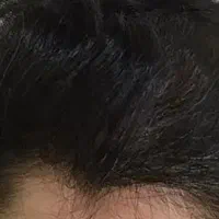 میکرواسکالپ مکمل کاشت مو و پرپشتی موی سر