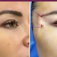 جشنواره ژل و بوتاکس