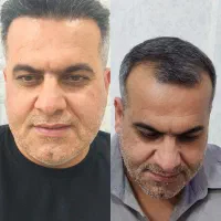 جشنواره تابستانی کاشت مو به روش میکرو گرفت