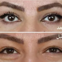 بلفارو پلاستی (بخیه لیزری)|خدمات آرایشگری و زیبایی|مشهد, دانشجو|دیوار
