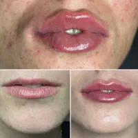 آموزش فیلر و بوتاکس و مزوژل