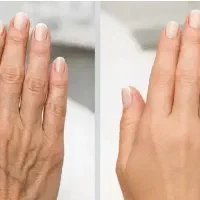 تزریق ژل وبوتاکس فول فیس. صورت تزریق فیلربادی