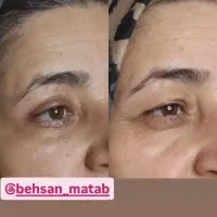 جشنواره بلفارو و تزریق چربی در  کلینیک زیبایی