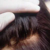 نابودی شپش و رشک با دستگاه تخصصی
