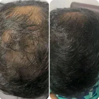 40 روزه پرپشتش کن