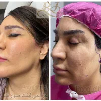 تخفیف مشاوره جراحی زیبایی صورت و لیپو شکم