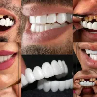 لمینت متحرک دندان