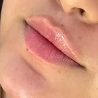 تزریق ژل و بوتاکس صورت