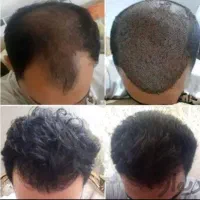 کاشت مو و ابرو اقساطی