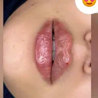 ژل بوتاکس بلفارو توسط پزشک پوست مو