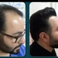 کاشت مو وابروفول تراکم با قیمت استثنایی