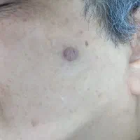 خالبرادری-گوشت اضافه- کک و مک -پی ار پی-