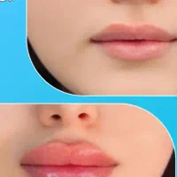 تزریق ژل وبوتاکس ،مزوتراپی،برداشتن خال وکک ومک