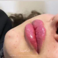 آف خدمات زیبایی ژل لب وصورت،چالگونه،پیرسینگ،لیفت