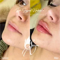 پوست مو زیبایی / فیلر ژل بوتاکس جوانسازی نخ لیفت
