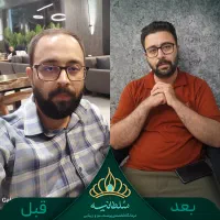 کاشت مو و کاشت شقیقه طبیعی و تراکم بالا