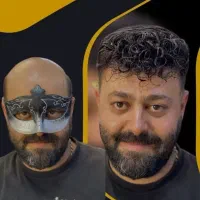 پروتز مو چسب پروتز