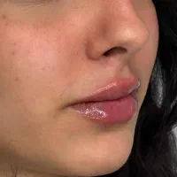 مدل تزریق