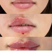 چربی،بوتاکس،فیلر،مزو،پی آر پی