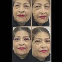 عمل زیبایی بینی در شاهرود