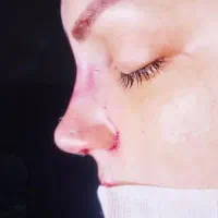 آف جراحی بینی فقط ۳۵ تا ۴۰ اهواز