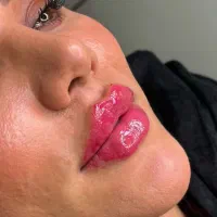 تزریق فیلر،بوتاکس،مزوژل جوانساز