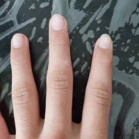 حذف زگیل تناسلی به صورت ریشه ای|خدمات آرایشگری و زیبایی|آمل, |دیوار