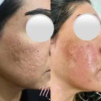 برداشت لک و فرو رفتگی صورت