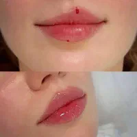 تزریق فیلر لب،گونه و زاویه فک زیرچشم در محمدشهر