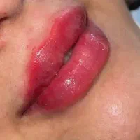 تزریق ژل فیلر بوتاکس مزو انریم پیرسینگ