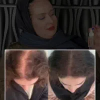 کاشت نکن بیا اینجا درستش کنیم فولیکول هاتو