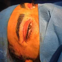 جراحب غبغب و پلک و لیفت صورت تخفیف ویژه تعطیلات