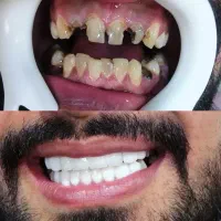 عصبکشی روکش کامپوزیت دندانپزشکی چیتگر آزادی خلیج