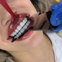 کامپوزیت از هرفک 10میلون تومان ،جرم گیری،ترمیم