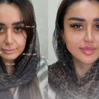 ژل و بوتاکس زیر نظر پزشک آف 40%