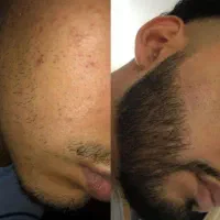 رشد بهتر ریش‌ها