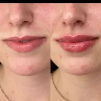 ژل لب بوتاکس گونه خط لبخند چونه