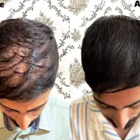 مشاوره تخصصی مو و زیبایی ریزش کم پشتی و چربی خشکی
